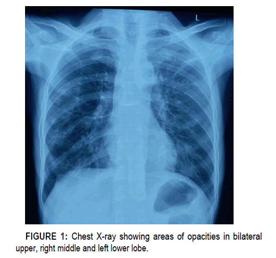 clinical-case-reports-opacities-bilateral