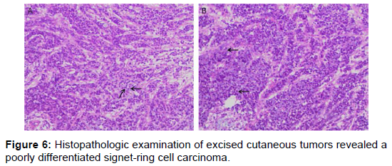 Journal of Gastrointestinal & Digestive System - Signet-ring Adenocarcinoma  of the Duodenum Spreading through Brunner's Gland Adenoma