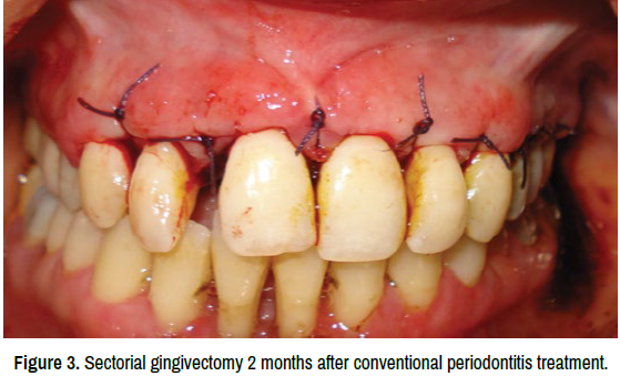 oral-health-case-reports-periodontitis-treatment