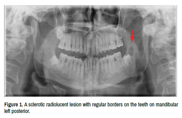 botryoid odontogenic cyst