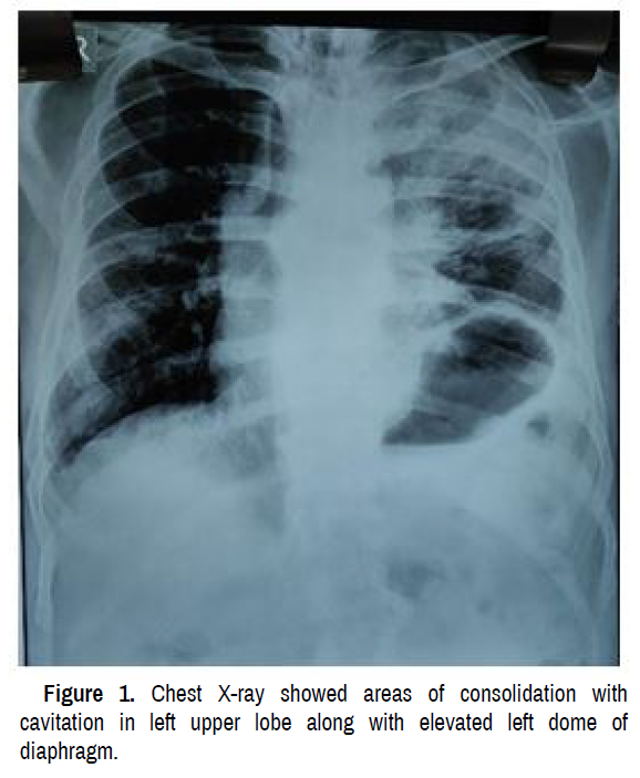 pulmonary-respiratory-medicine-cavitation