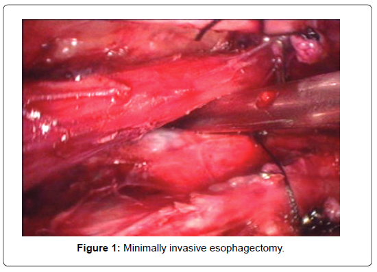 aids-clinical-research-esophagectomy