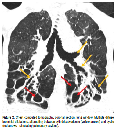 Review Chest high-resolution computed tomography in primary Sjögren's  syndrome: an up-to-date primer for rheumatologists