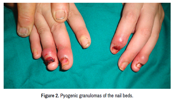 clinical-case-reports-granulomas