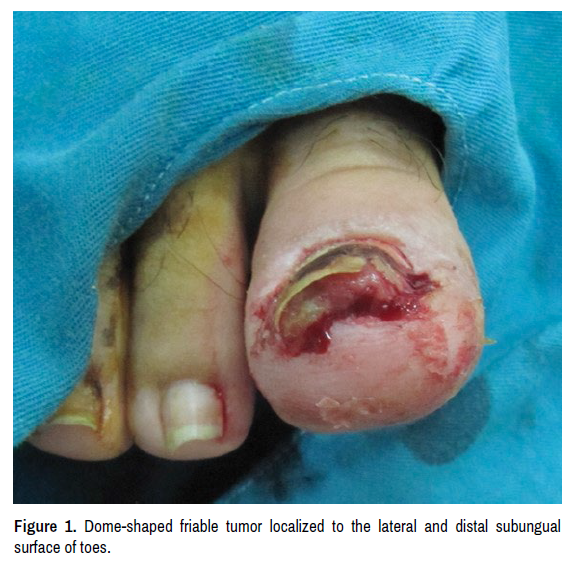 clinical-case-reports-subungual