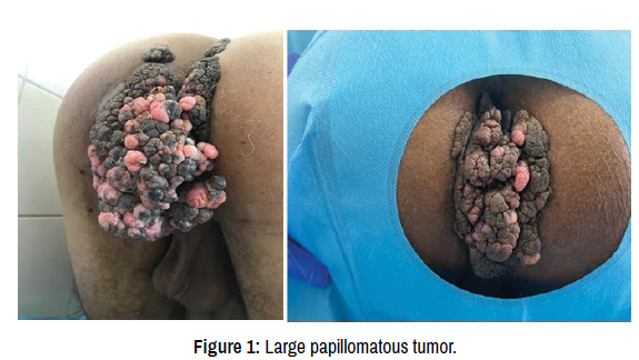 clinical-medical-case-reports-papillomatous
