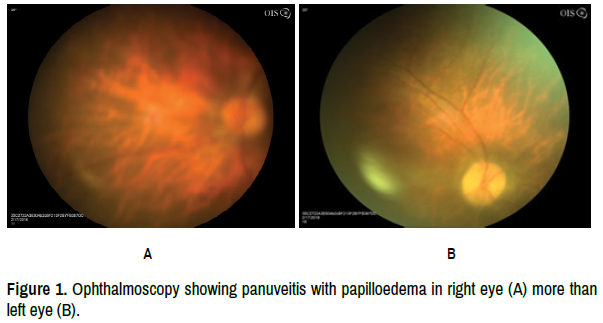 BehÃ§et's Disease Presenting as Cerebral Venous Thrombosis