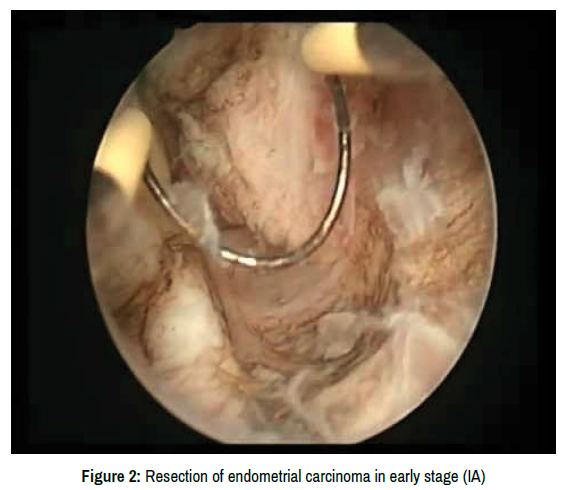 surgery-endometrial-carcinoma