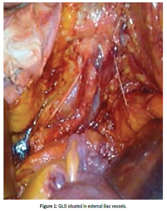 surgery-iliac-vessels