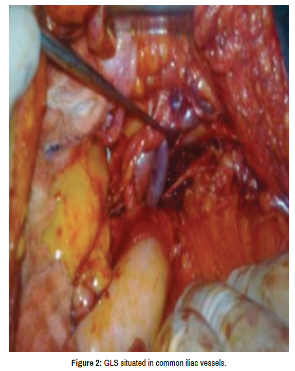 surgery-iliac-vessels