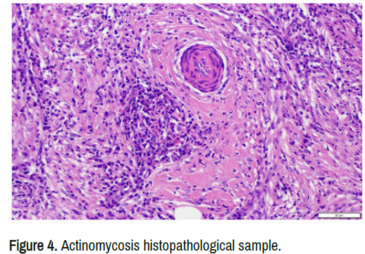 clinical-medical-case-reports-actinomycosis